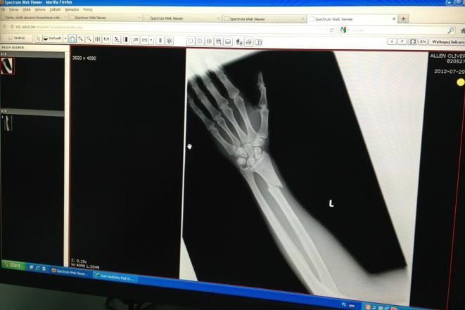 Najlepszy żużlowiec „Rekinów” złamał rękę (wideo – zobacz wypadek), rowrybnik.com
